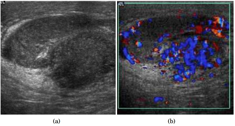 Testicular Ultrasound